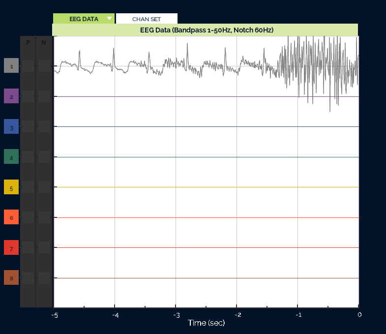 OpenBCI Screenshot of EKG test data with EMG artifacts